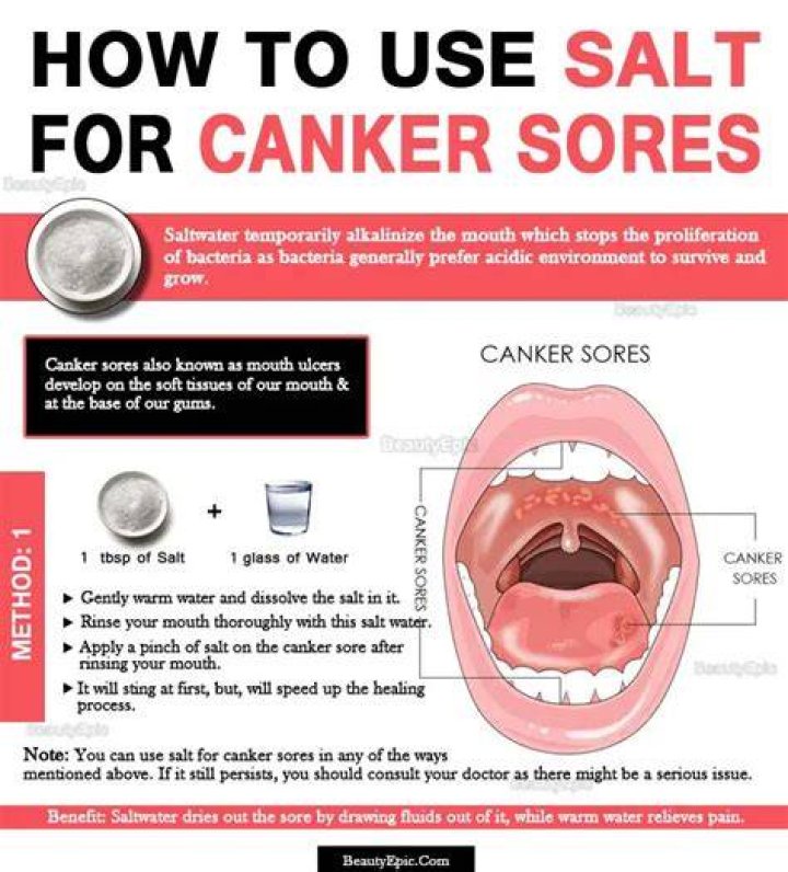 Salt On Canker Sore