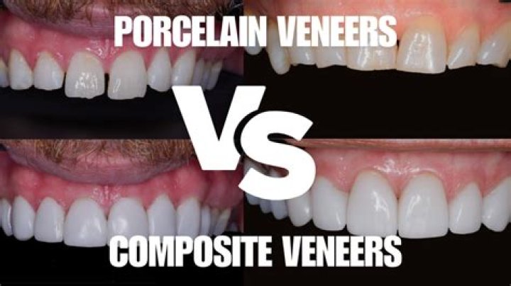 Veneers are porcelain
