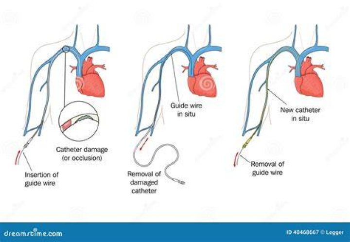 What is a Hohn catheter